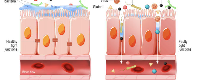 Leaky Gut Syndrom und Reizdarmsyndrom